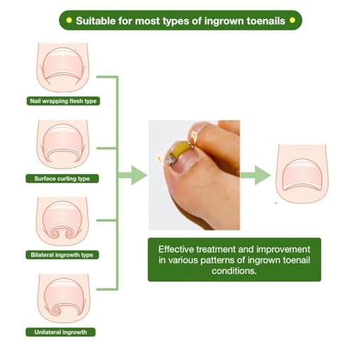 Ingrown Toenail Treatment & Corrector with Latex Elasticity - Curved Toenail Straightener | Effective Daily Solution for Ingrown Toenail Pain & Growth Correction [S/0.67inches/16-18mm]