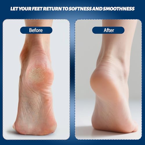 Electric Feet Foot Callus Remover Equipped with A Vacuum System Foot Scrubber 17 in 1 Professional Foot Care Tool Ipx6 Waterproof Rating for Removing Hard Cracks Dryness and Dead Skin (Black)