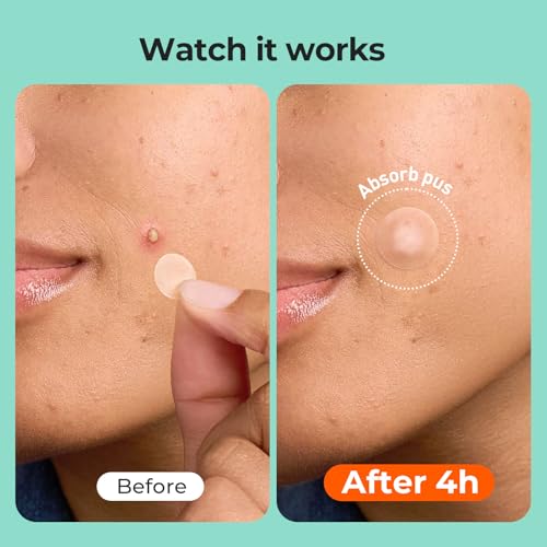 TKTK Pimple Patches for Face, 6 Sizes Hydrocolloid Acne Patch Variety, Large Acne Stickers for Cheeks, Forehead, Chin, Nose, Back Blemishes Zit Breakouts (4 Shapes 356 Count)