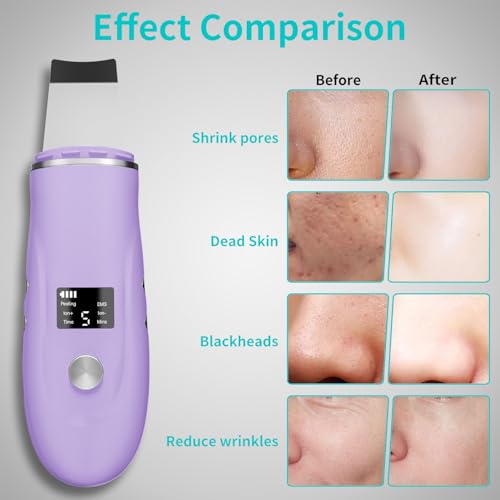 Face Scrubber Skin Spatula - Blackhead Remover Deep Cleansing Tool for Pore Extraction, 4-in-1 Fast Charging Dock Blackhead Remover Face Spatula for Facial Skincare Women Gift (Purple)