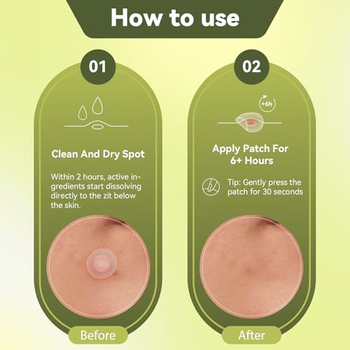 Microdart Hydrocolloid Acne Patch 24 Counts,Pimple Patch Hyaluronate Acid & Salicylic Acid Pimples Overnight for Deep, Early and Hidden Blemishes
