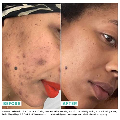 Urban Skin Rx¢ç Witch Hazel Brightening & pH Balancing Toner, Exfoliated & Clarifies Clogged Pores, Improves The Appearance of Uneven Skin Tone, Reduces Redness & Brightens Dull Complexions, 4.5 Fl Oz