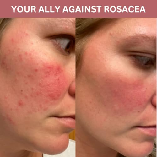 Clarity Vitamin C Serum - 3% Tranexamic Acid, 10% Vitamin C (SAP), 3.5% Niacinamide & Aloe Vera. Discoloration & Brightening Serum. Evens Skin Tone. Fragrance Free. 2fl oz.