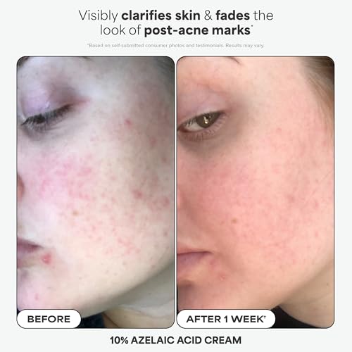 Paula's Choice Complexion Clarity Kit, 3 Piece Set Includes Full-Sized 2% BHA Exfoliant, 1% Retinol Treatment, Full-Sized 10% Azelaic Acid Booster, Skin Care Set for Clear, Glowing Skin