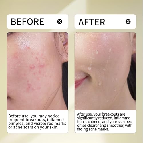 Multi-Acid 20% Serum ? 10% Azelaic Acid + 3% Tranexamic Acid + 5% Zinc PCA + 2% Salicylic Acid,Targets Blemishes & Breakouts,Ideal for Acne-Prone & Uneven Skin