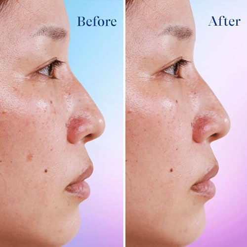 Differin Dark Spot Correcting Face Serum, Dark Spot Correcting Serum by the makers of Differin Gel, Gentle Skin Care for Acne Prone Sensitive Skin, 1 oz (Packaging May Vary)