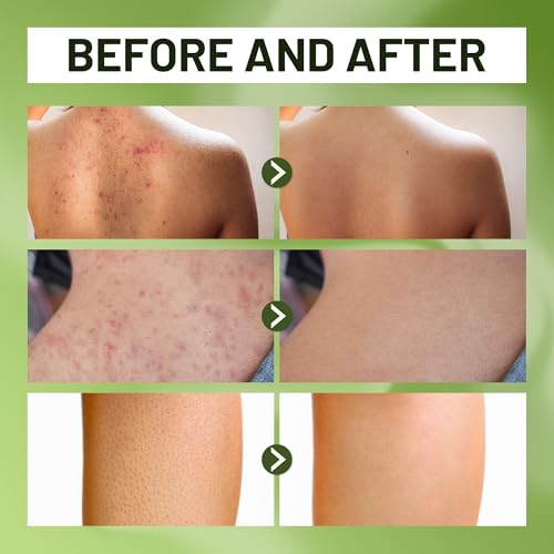 ABERA Folliculitis BHA Shower Gel, High-Performance Folliculitis Body Wash, Wild Bitter Melon Extract, Reduces Back Acne & Hyperkeratosis, 2 Boxes + Gift Grapefruit Shampoo for Hair Loss