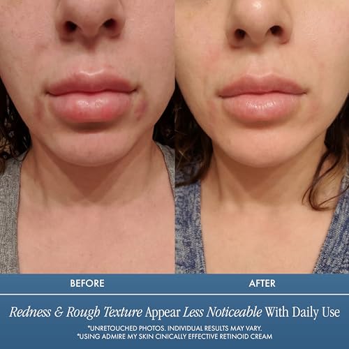 Admire My Skin Potent Retinoid Cream - Anti Aging Retinol Cream Moisturizer to Help Clear Acne Prone Skin, Eliminate Wrinkles and Provide You With That Healthy Youthful Glow