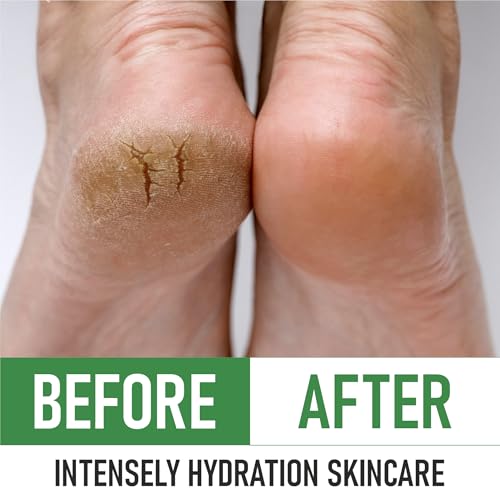 Urea 40% Foot Cream ? Made in USA, Dermatologist Tested, Intensive Repair for Dry, Cracked Heels, Calluses & Rough Feet, Professional Strength Exfoliating & Moisturizing Cream - Pack of 3