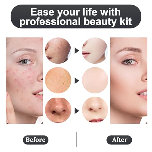 Titanium Alloy Pimple Popper Tool kit Blackhead Remover Comedone Extractor Kit with Box for Easily Remove blackheads, Acne, Blemishes, Whiteheads, pimples and Papules from The face and Bonus Gift