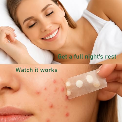 Original Hydrocolloid Acne Patches (17 Count) | Medical Grade for Cystic Breakouts, Invisible Spot Treatment & Overnight Healing