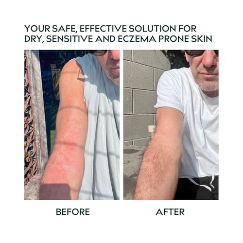 Herbitual Eczema Relief Balm ? Soothing Moisturizer for Face & Body, Dry & Sensitive Skin Barrier Protectant Cream, Flare-Up Treatment for Itchy, Irritated Skin, Steroid & Fragrance-Free