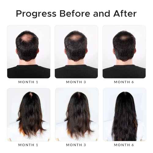 Minoxidil & Biotin Shampoo for Hair Growth - Enriched with Caffeine, Castor Oil & Onion - DHT Blocker for Thicker, Healthier Hair - Strengthening Formula for Men & Women