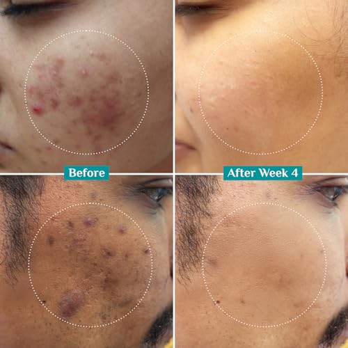 Pilgrim 10% Niacinamide + 1% Zinc Serum | Acne Control & Oil Balancing | Smoothing Serum for Blemish-Prone Skin | All Skin Types | For Women & Men | 1.01 Fl Oz (30 ml)