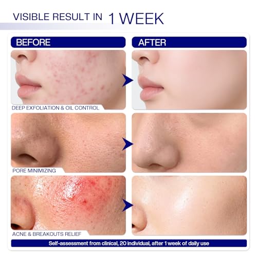 Morovan Glycolic Acid Pads 30%: Dual-Sided Face Exfoliator for Blemishes and Deep Cleaning, Clarifying Skin Tone, At-Home Peel, 65 Pads
