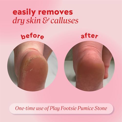Onyx Professional Double Sided Pumice Stone, 2 Pack - 100% Siliglass Callus Remover for Feet, Elbows, Knees, Dead Skin, Heels, Hands, Foot File Scrubber Exfoliator, Pumice Stone for Feet