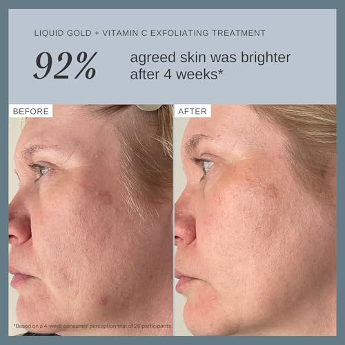 Alpha-H Liquid Gold + Vitamin C Exfoliating Treatment 100ml - Brighten, Even Tone, Smooth Texture, Reduce Appearance of Fine Lines - At-Home Skin Renewal for All Skin Types