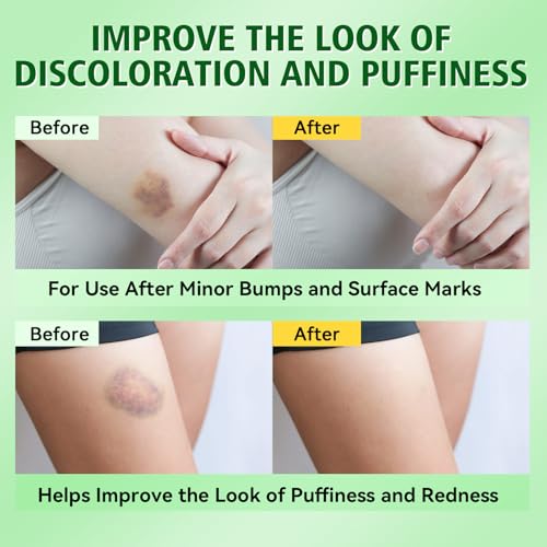 Arnica Bruise Cream, Advanced Formula Arnica Cream for Bruising and Swelling with Plant Extract, for Thin Skin on Face and Body 4 oz
