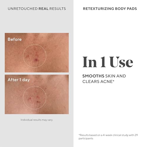 Murad Retexturizing Body Pads ? Acne-Fighting Exfoliating Pads with Azelaic, Salicylic, and Glycolic Acid for Acne Breakouts, Smoothing KP Bumps, and Soothing Aggravated Skin ? 45 Pads