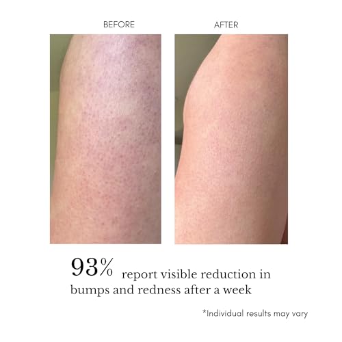Keratosis Pilaris Treatment, KP Bump Eraser - Texture Refining Body Serum for KP, Ingrown Hairs, & Body Breakouts, Advanced Triple-Acid Complex with 5% Glycolic Acid, AHA/BHA/PHA 120 ml
