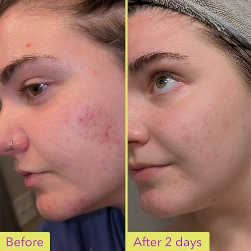 Good Molecules 10% Azelaic Acid Treatment for Face ? Soothing Formula for Facial Redness & Uneven Tone ? Brightens Dark Spots & Refines Texture ? Vegan & Fragrance-Free Skincare (30ml / 1.01 fl oz.)