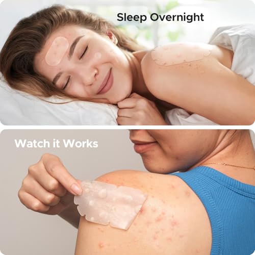 XXL Pimple Patches for Body, Large Acne Patches, 5 Sizes Big Hydrocolloid Bandages for Back, Chest, Shoulders Zit Breakouts, Blemish Stickers for Face (Oval, Dot 110 Count)