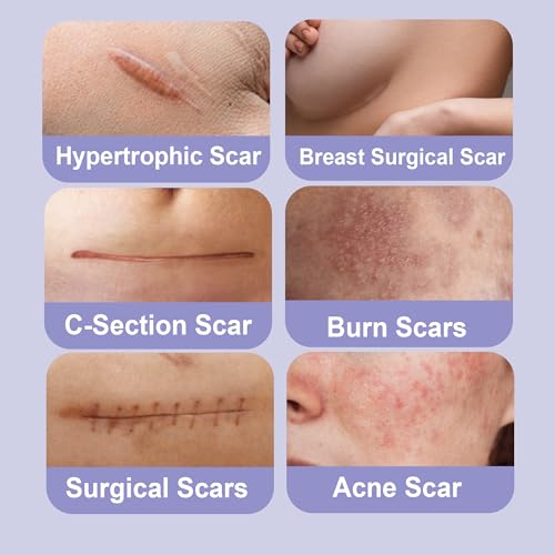 Silicone Scar Removal Tape (1.6" x 120" Roll - 3M), Medical Grade Silicone Scar Removal Sheets, Hypoallergenic for New and Old Scars ? Surgery, Burns, Acne, Keloids, Stretch Marks, C-Section