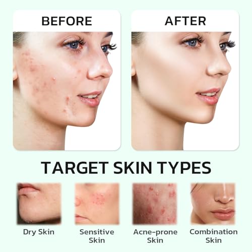 PDRN Cream Centella Moisturizer Phytocin Salmon Cream Face Soothing Hydration Barrier Repair Calming, for Acne Prone & Sensitive Skin with Ceramide, B5 (30ml)