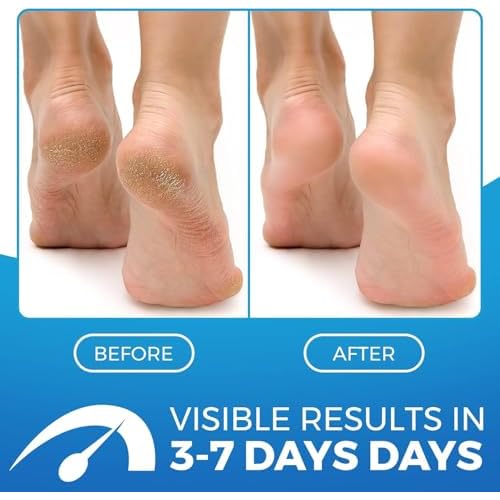 2 in 1 Foot Cream for Dry Cracked Heels - XL Foot Repair Cream for Dry Feet - Suitable for Diabetics - Used by Professionals