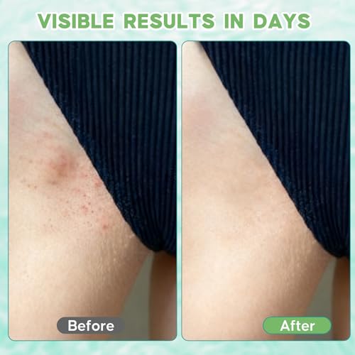 Ingrown Pubic Hair Cyst Treatment Gel, Razor Bumps Solution for Bikini Line, Intimate Area & Inner Thighs, Safe After Waxing or Shaving, Natural Formula, Gentle for Sensitive Skin - for Men and Women