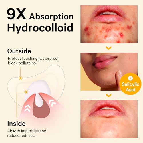 Sosky Chin Pimple Patches Hydrocolloid Acne Patches for Breakouts Large Spot Control Covers for Face Chin & Body with Tea Tree & Calendula Oil Vegan Cruelty Free (10 Count)