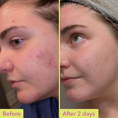 Good Molecules 10% Azelaic Acid Treatment Pack 3 ? 30 ml Each | Soothing Facial Formula for Uneven Tone with Azelaic Acid ? Vegan & Fragrance-Free Skincare