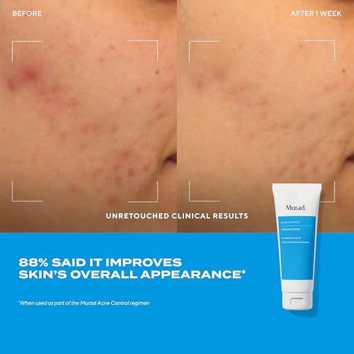 Acne Treatment Trial Kit ? Salicylic Acid & Mandelic Acid for Clear Skin ? Oil Control, Spot Treatment & Cleanser ? Travel Size Skincare for Acne-Prone Skin