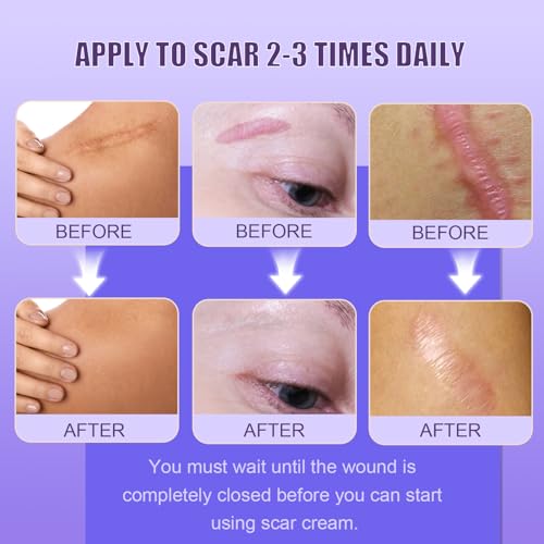 Silicone Scar Cream Scar Gel - Advanced Scar Removal Cream for Surgical Scars, Stretch Marks, Acne, C-Section, Keloids, Old & New Scars Scar Treatment from Body & Face, 35g (1.23Oz)