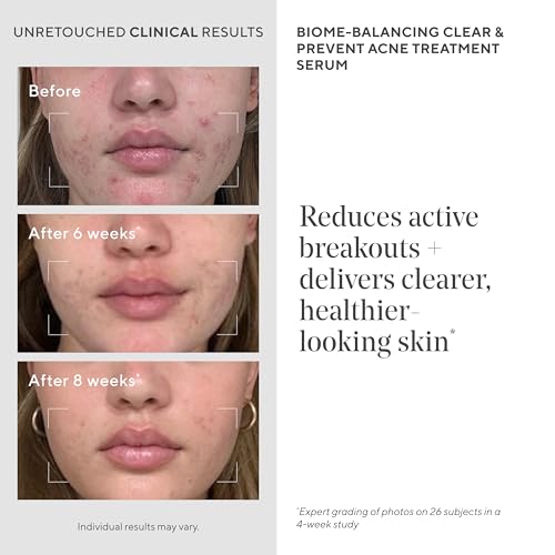 Acne Treatment Trial Kit ? Salicylic Acid & Mandelic Acid for Clear Skin ? Oil Control, Spot Treatment & Cleanser ? Travel Size Skincare for Acne-Prone Skin