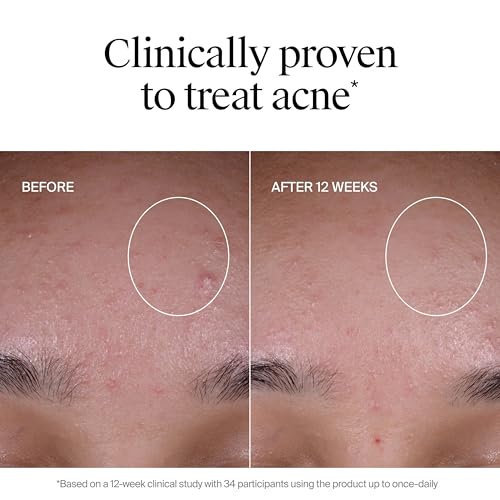 Neutrogena Evenly Clear Acne Exfoliant with Salicylic Acid & Mandelic Acid, Multi-Acid Face Exfoliating Treatment Serum Visibly Fade the look of Post-Acne Marks for A Smooth, Even Skin Tone, 1 fl. oz