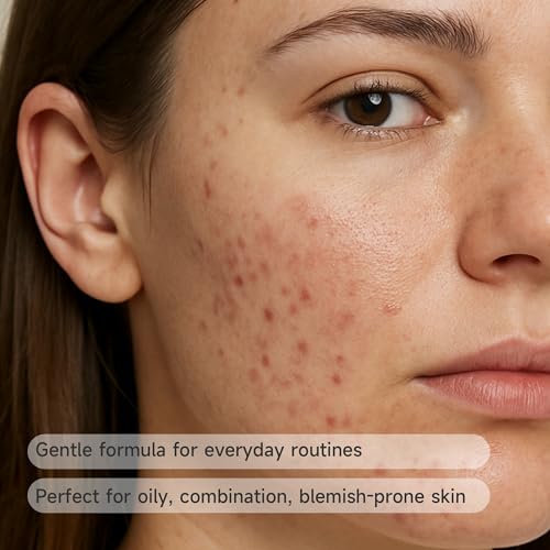 Azelaic Acid 10% + Salicylic Acid 2% Facial Serum for Oily & Blemish-Prone Skin, Daily Post-Breakout Care, Lightweight Serum, 30ml (1 Fl Oz)