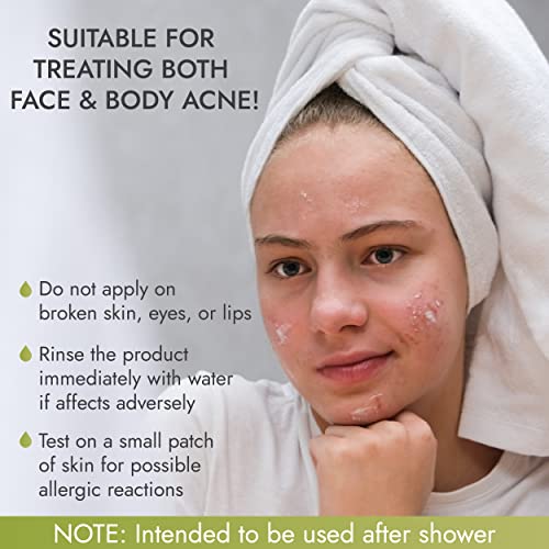 Acne Spot Pimple Drying Lotion - For Face and Body Use, Dries Out Blemishes and Pores - 1oz