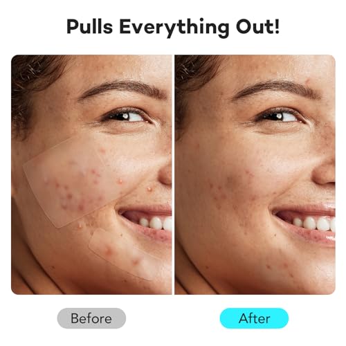 LitBear Large Pimple Patches for Face (6 Sizes 118 Pcs), Big Hydrocolloid Acne Patches, XL Hydrocolloid Bandages for Body, Cheek, Forehead, Chin, Full Face, Back, Nose