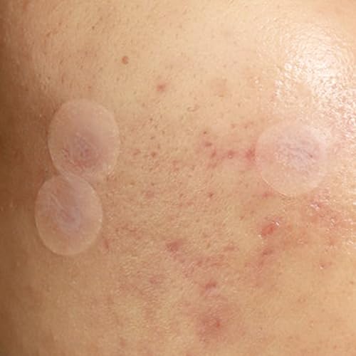 Julep Patch Me Up Waterproof Pimple Patches for Face ? 72 Hydrocolloid Clear Acne Patches with Tea Tree Oil, Ultra-Thin Acne Stickers, Reduces Blemishes & Scarring ? 48 8mm & 24 12mm Patches