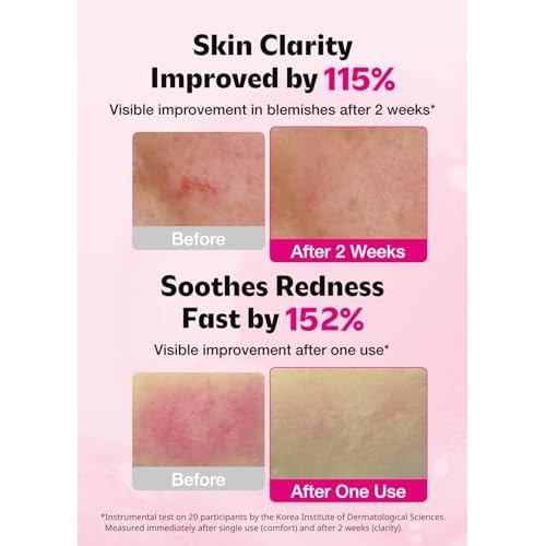 ISOI Blemish Care Up Serum for Face, Vegan Hydrating Serum for Smooth & Glass Skin Effect, Skin Barrier & Moisture Balance for Women, Arbutin & Rose Otto Oil, Korean Skin Care (1.18 fl. oz, 35ml)