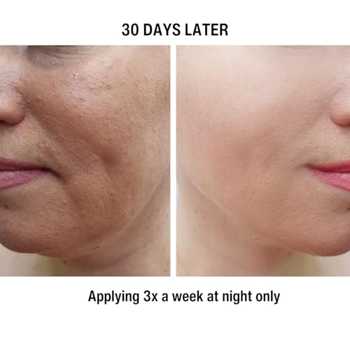 gymsegb? 20% Glycolic + 10% Lactic Acid AHA Chemical Peel ? Professional Facial Exfoliant with 3% Hyaluronic Acid for Texture, Dark Spots & Pores ? Fragrance?Free, Sensitive Skin & Melanin?Safe - 30ml