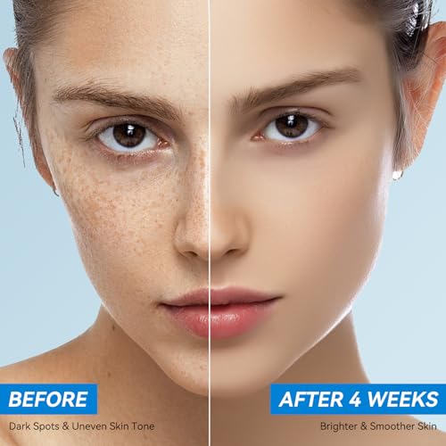 Dark Spot Remover Face and Body, Dark Spot Corrector Cream for Age Spot Sun Spot Melasma Freckles, Rapid Corrects Uneven Skin Tone, with Hyaluronic Acid and Retinol for Women and Men