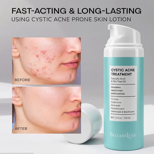 Cystic Acne Treatment for Face: Hormonal Acne Treatment Cream for Teens & Adults - Salicylic Acid & Tea Tree Oil Pimple Spot Remover - Anti-Acne Moisturizer Reduces Redness, Blemishes