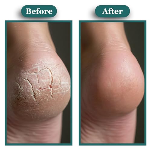 Kissable Feet, Athletes Foot Cream ? Cream for Itchy, Dry Skin ? Tea Tree, Coconut & Chamomile ? Crafted for the Whole Family, No Sting ? 3.5 oz