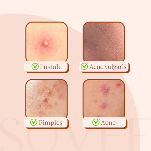 Pimple Patches for Face (96 Count) ? Invisible Hydrocolloid Acne Patches with Tea Tree & Salicylic Acid ? Waterproof Zit Stickers for Overnight, Makeup & Sensitive Skin