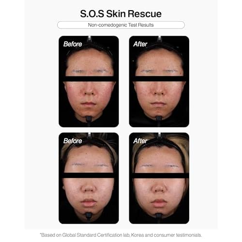 Betelchlorous S.O.S Rescue Dose ? Hypochlorous Acid Face Serum for Acne, Redness & Sensitive Skin, Soothing Korean Skincare Serum, 30ml (1.014 fl oz)