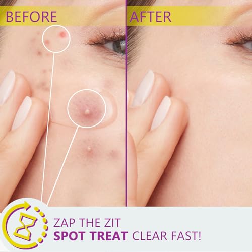 Azelaic Acid, 12% Azelaic Acid For Face Serum Rich in Niacinamide and Hyaluronic Acid, Fades Post Acne Marks and Calms Redness, Formula for Uneven and Blemish Prone Skin Care 2 OZ, 2 Packs
