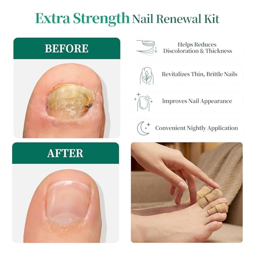 APUREE Fungal Nail Patches Extra Strength: True 1% Tolnaftate | 8H Overnight Fungal Toe Nail Treatments |Repair For Discolored Yellow Brittle Damage Nails| Revives Natural look| 64 Patch