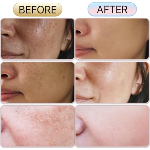 Crema para Manchas Oscuras en la Cara, Cremas para Quitar Manchas de la Cara, Cremas Hidratante paras Melasma en las Cara, Crema Blanqueadora paras las Manchas de la Cara for Mujer & Hombre (3)